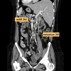 X-Ray diagram of IVC occlusion and filter